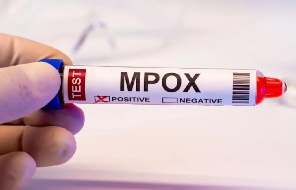 Mpox: Brasil Registra 88 Casos em 2026 e Como se Proteger da Doença Mpox: Brasil Registra 88 Casos em 2026 e Como se Proteger da Doença